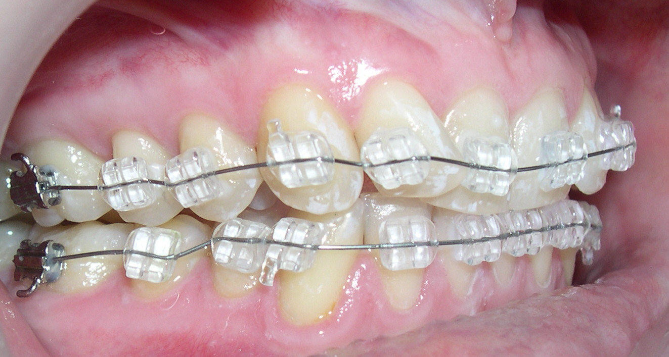 Как выглядят керамические брекеты на зубах фото
