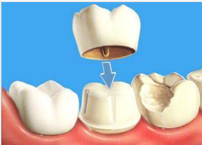 Коронки на зуб