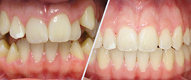 Лечение брекет-системой без удаления зубов