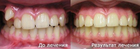 Дистопия 13 зуба, ДентИдеал
