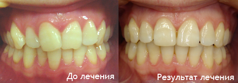 Тесное положение зубов, брекеты