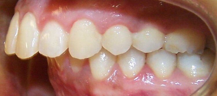 Удаление зуба при ортодонтическом лечении