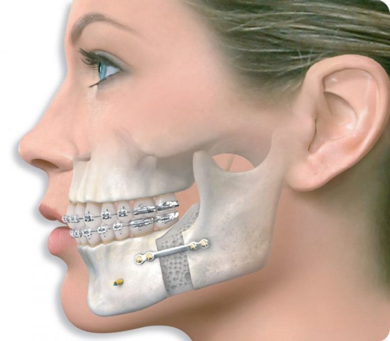 Выравнивание зубов с помощью операции