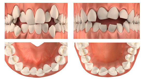 Какие зубы удаляют при ортодонтическом лечении