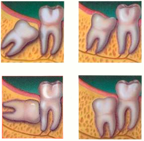 Удаление зуба при ортодонтическом лечении